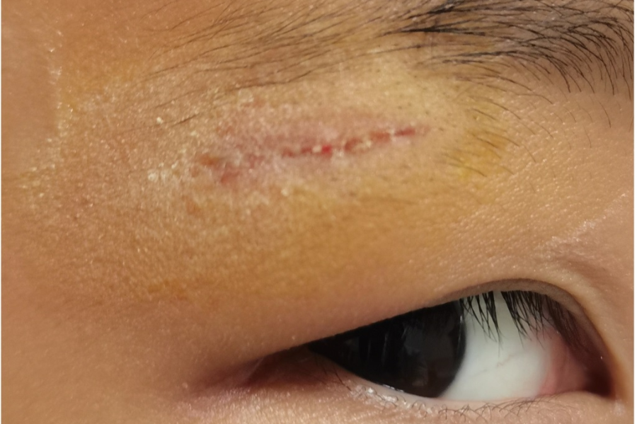 怎么买医用胶水伤口不缝针，“神奇”胶水一黏就好！_https://www.jmylbn.com_新闻资讯_第3张