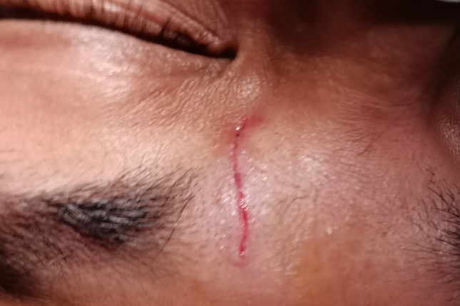 怎么买医用胶水伤口不缝针，“神奇”胶水一黏就好！_https://www.jmylbn.com_新闻资讯_第2张