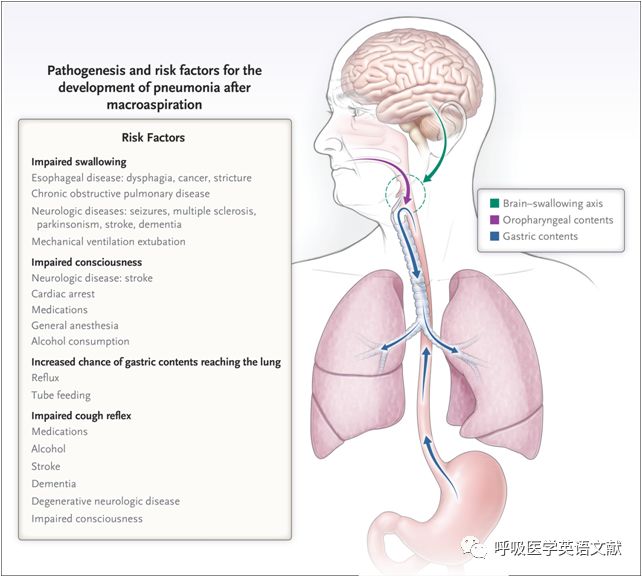 肺炎 维基百科 自由的百科全书