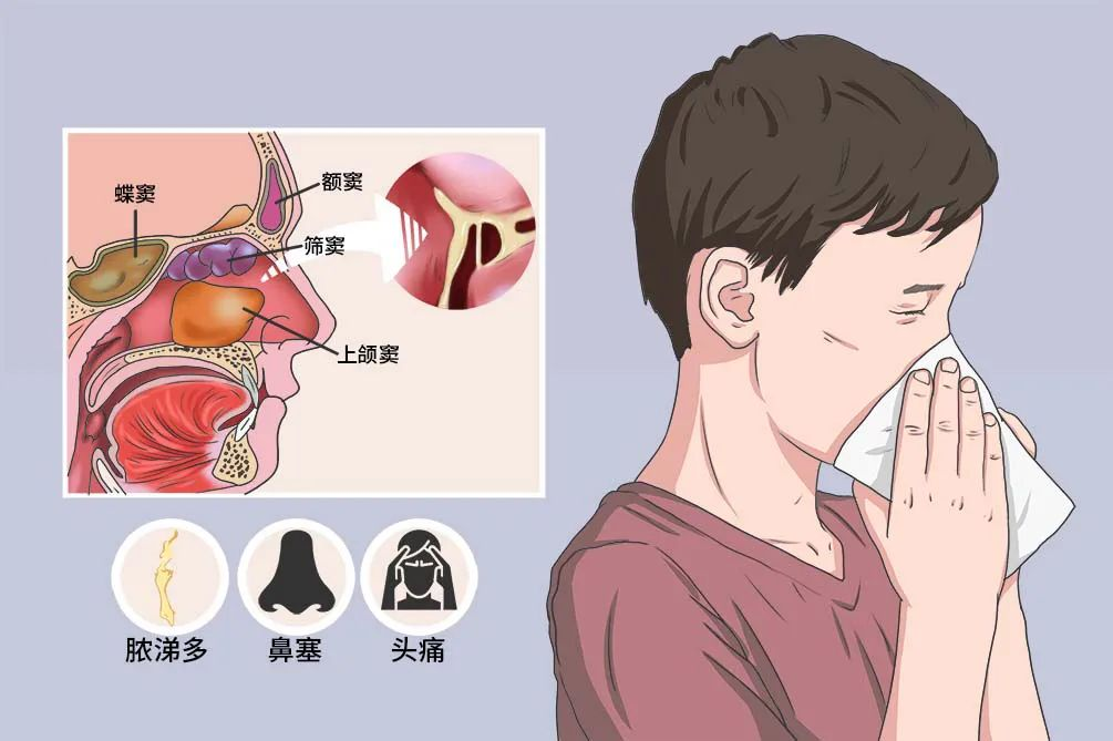 如何科学有效的治疗鼻窦炎？