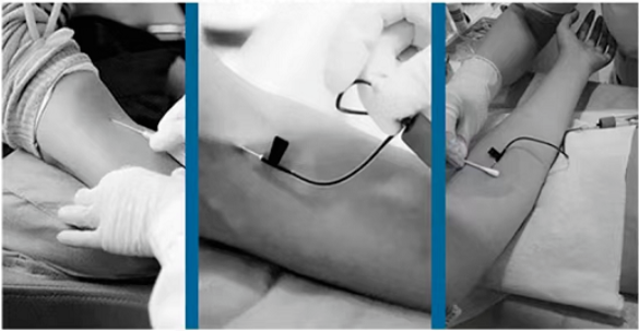 一次性采血针怎么用朱氏风物 ｜ 减少医疗事件，一次性使用防针刺静脉采血针，防止刺伤，造成二次污染_https://www.jmylbn.com_新闻资讯_第2张