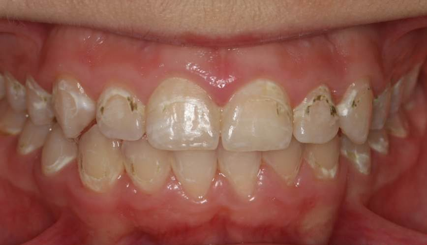 dmg口腔材料怎么使用DMG-Icon专利之渗透树脂（内含操作视频）_https://www.jmylbn.com_新闻资讯_第6张