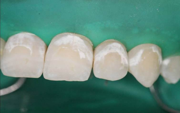 dmg口腔材料怎么使用DMG-Icon专利之渗透树脂（内含操作视频）_https://www.jmylbn.com_新闻资讯_第10张