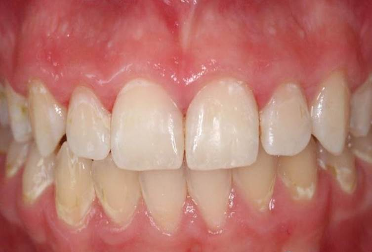 dmg口腔材料怎么使用DMG-Icon专利之渗透树脂（内含操作视频）_https://www.jmylbn.com_新闻资讯_第14张