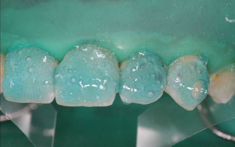 dmg口腔材料怎么使用DMG-Icon专利之渗透树脂（内含操作视频）_https://www.jmylbn.com_新闻资讯_第8张