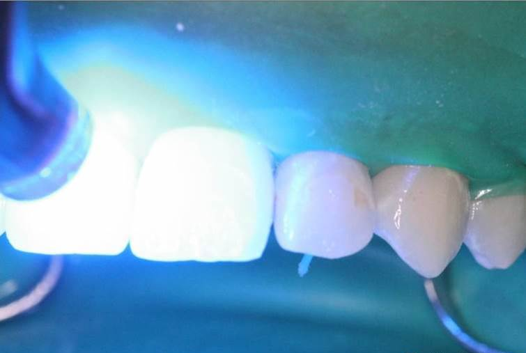 dmg口腔材料怎么使用DMG-Icon专利之渗透树脂（内含操作视频）_https://www.jmylbn.com_新闻资讯_第13张