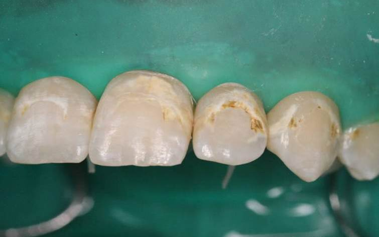 dmg口腔材料怎么使用DMG-Icon专利之渗透树脂（内含操作视频）_https://www.jmylbn.com_新闻资讯_第7张