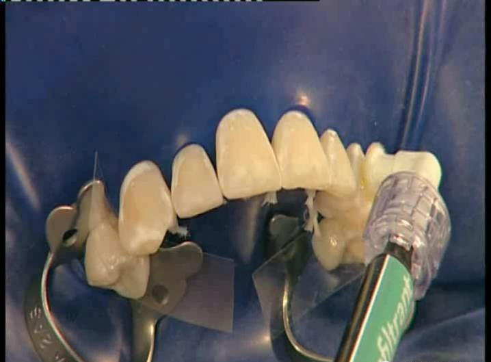 dmg口腔材料怎么使用DMG-Icon专利之渗透树脂（内含操作视频）_https://www.jmylbn.com_新闻资讯_第12张