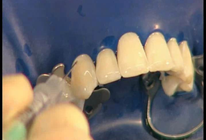 dmg口腔材料怎么使用DMG-Icon专利之渗透树脂（内含操作视频）_https://www.jmylbn.com_新闻资讯_第9张