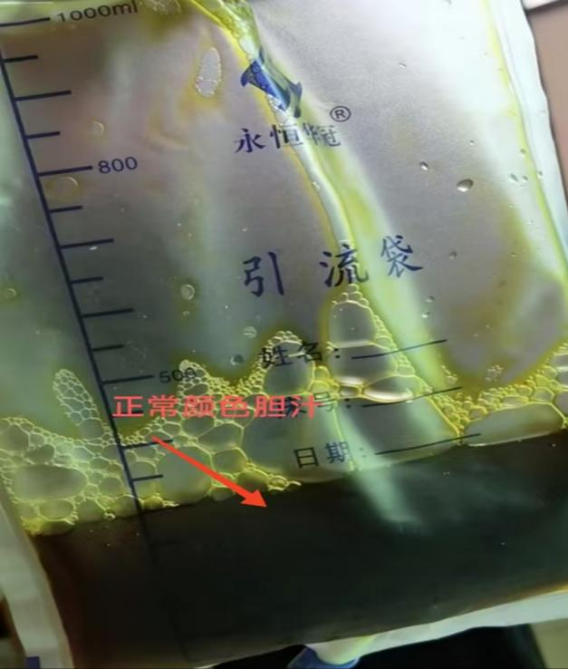 介入引流管怎么关“小针孔、治大病”介入血管外科技术之经皮经肝胆囊穿刺置管引流术_https://www.jmylbn.com_新闻资讯_第11张