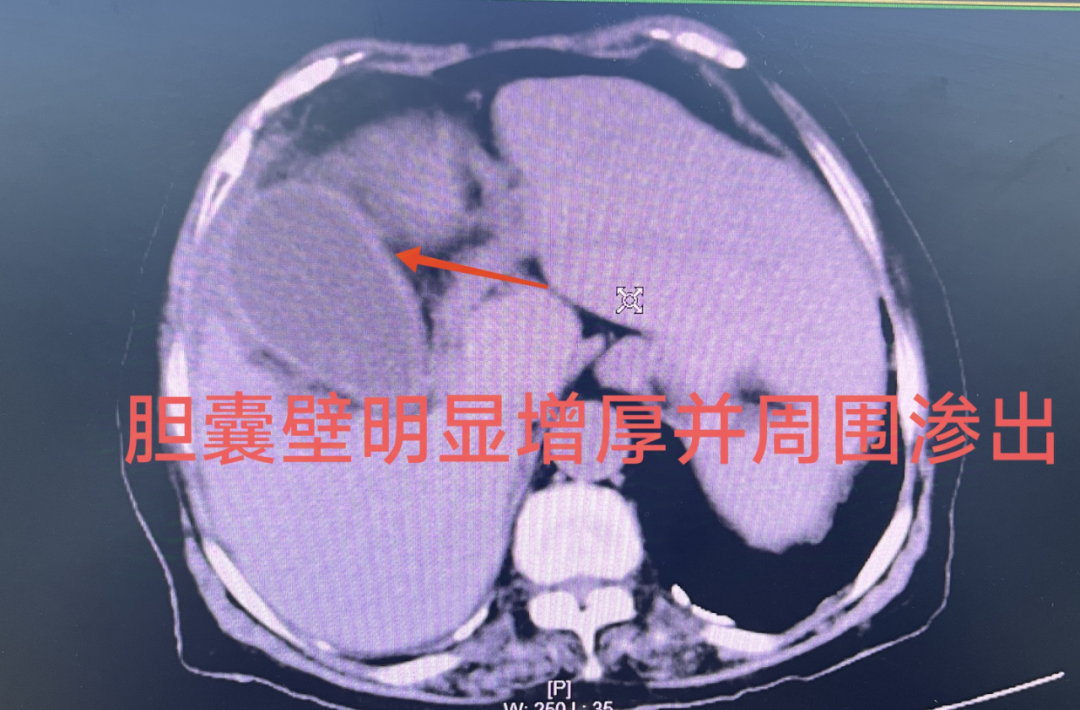 介入引流管怎么关“小针孔、治大病”介入血管外科技术之经皮经肝胆囊穿刺置管引流术_https://www.jmylbn.com_新闻资讯_第2张