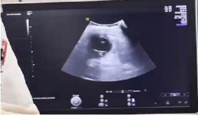 介入引流管怎么关“小针孔、治大病”介入血管外科技术之经皮经肝胆囊穿刺置管引流术_https://www.jmylbn.com_新闻资讯_第7张