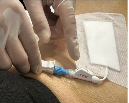 介入引流管怎么关“小针孔、治大病”介入血管外科技术之经皮经肝胆囊穿刺置管引流术_https://www.jmylbn.com_新闻资讯_第9张