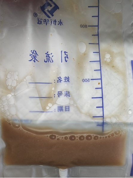 介入引流管怎么关“小针孔、治大病”介入血管外科技术之经皮经肝胆囊穿刺置管引流术_https://www.jmylbn.com_新闻资讯_第10张