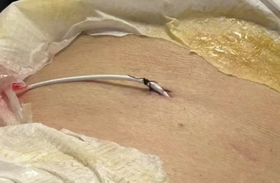 介入引流管怎么关“小针孔、治大病”介入血管外科技术之经皮经肝胆囊穿刺置管引流术_https://www.jmylbn.com_新闻资讯_第8张