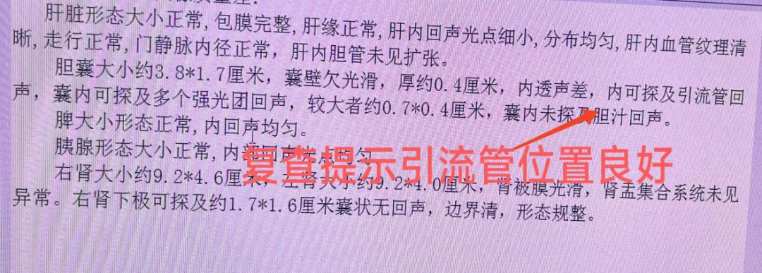 介入引流管怎么关“小针孔、治大病”介入血管外科技术之经皮经肝胆囊穿刺置管引流术_https://www.jmylbn.com_新闻资讯_第12张