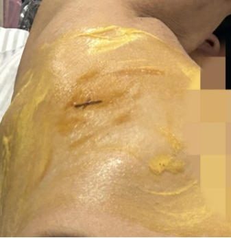 介入引流管怎么关“小针孔、治大病”介入血管外科技术之经皮经肝胆囊穿刺置管引流术_https://www.jmylbn.com_新闻资讯_第5张