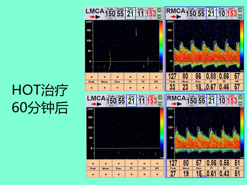 高压臭氧治疗什么“高剂量高压臭氧大自血疗法HOT”治疗急性脑梗死过程中的血流量变化！_https://www.jmylbn.com_新闻资讯_第6张