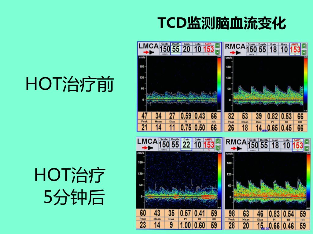 高压臭氧治疗什么“高剂量高压臭氧大自血疗法HOT”治疗急性脑梗死过程中的血流量变化！_https://www.jmylbn.com_新闻资讯_第3张