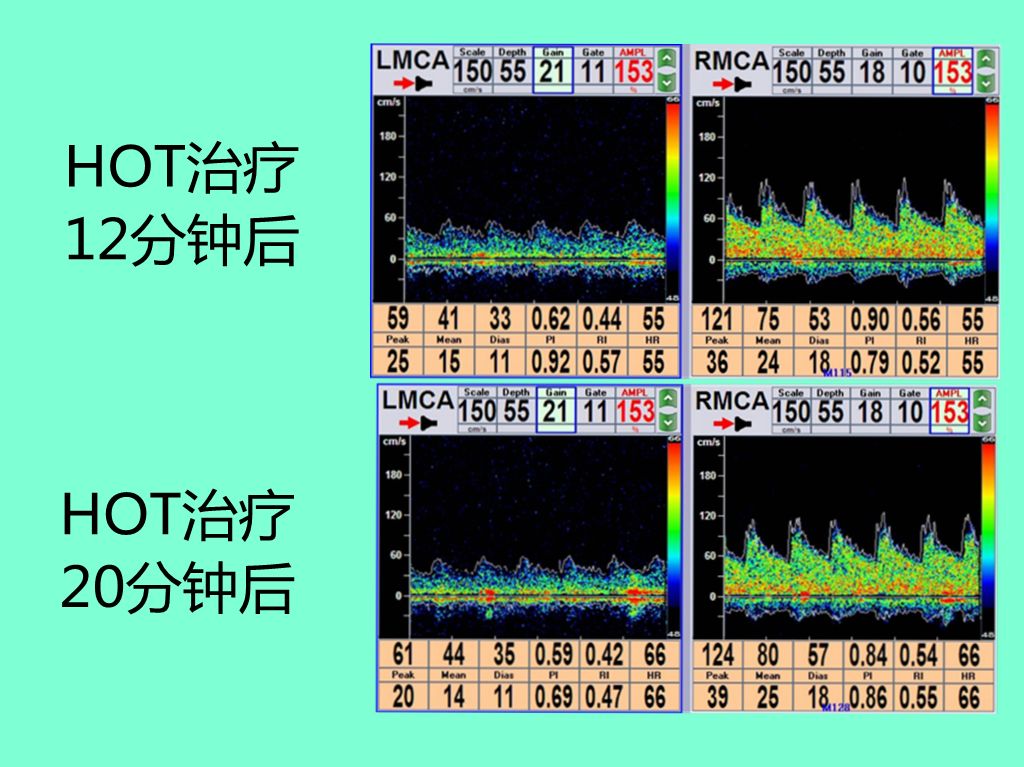 高压臭氧治疗什么“高剂量高压臭氧大自血疗法HOT”治疗急性脑梗死过程中的血流量变化！_https://www.jmylbn.com_新闻资讯_第5张