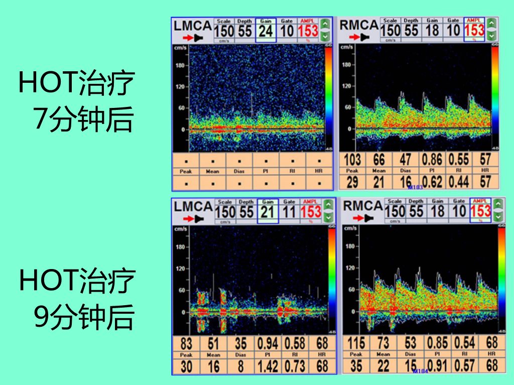 高压臭氧治疗什么“高剂量高压臭氧大自血疗法HOT”治疗急性脑梗死过程中的血流量变化！_https://www.jmylbn.com_新闻资讯_第4张