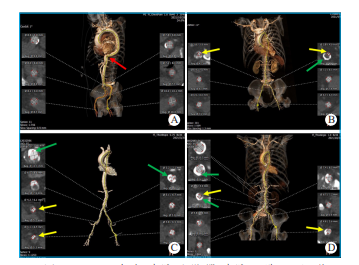 动脉长鞘怎么置入【文章精选】经导管主动脉瓣置换术下肢入路评估处理策略与技巧_https://www.jmylbn.com_新闻资讯_第1张