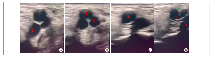 动脉长鞘怎么置入【文章精选】经导管主动脉瓣置换术下肢入路评估处理策略与技巧_https://www.jmylbn.com_新闻资讯_第2张