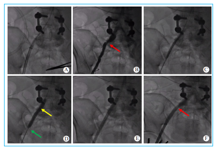 动脉长鞘怎么置入【文章精选】经导管主动脉瓣置换术下肢入路评估处理策略与技巧_https://www.jmylbn.com_新闻资讯_第6张