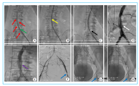 动脉长鞘怎么置入【文章精选】经导管主动脉瓣置换术下肢入路评估处理策略与技巧_https://www.jmylbn.com_新闻资讯_第5张