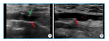 动脉长鞘怎么置入【文章精选】经导管主动脉瓣置换术下肢入路评估处理策略与技巧_https://www.jmylbn.com_新闻资讯_第3张