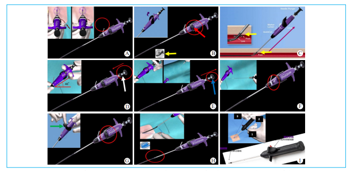 动脉长鞘怎么置入【文章精选】经导管主动脉瓣置换术下肢入路评估处理策略与技巧_https://www.jmylbn.com_新闻资讯_第4张