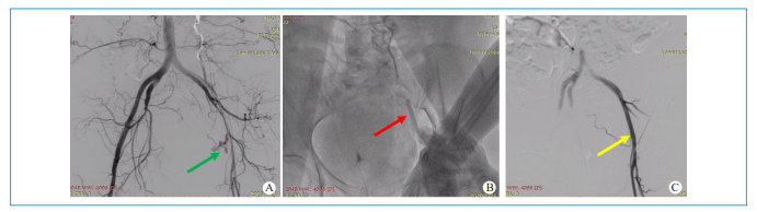 动脉长鞘怎么置入【文章精选】经导管主动脉瓣置换术下肢入路评估处理策略与技巧_https://www.jmylbn.com_新闻资讯_第7张