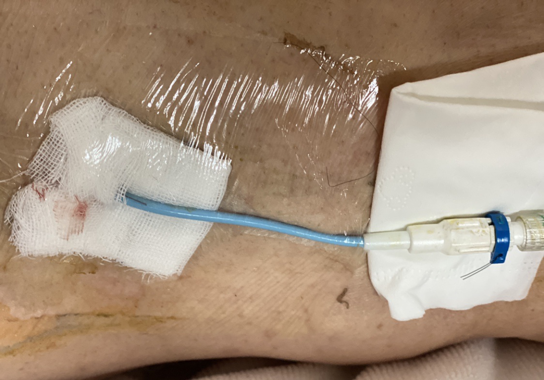 引流袋管子怎么不流告别引流袋，老人的心愿终于实现！_https://www.jmylbn.com_新闻资讯_第3张