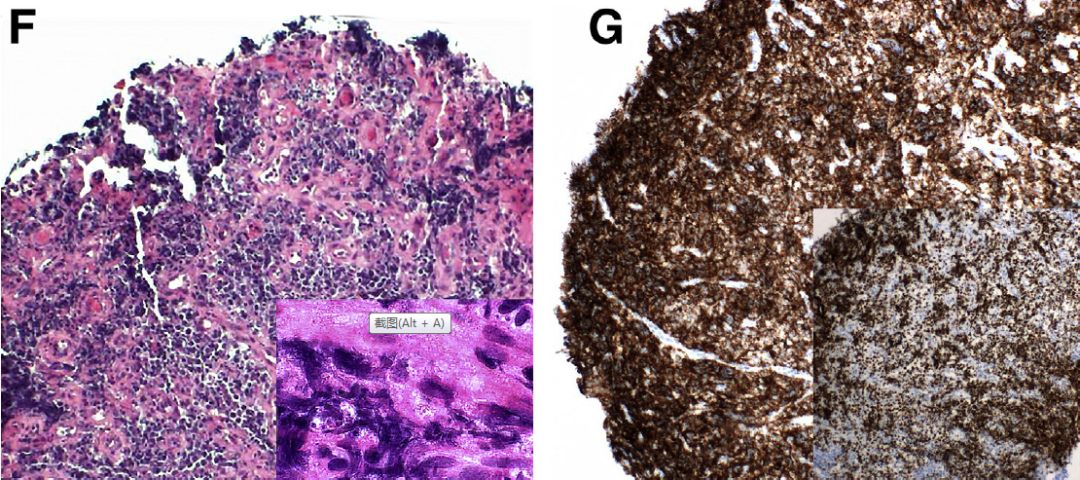 潰結緩解期出現血性腹瀉，潰結復發？ | 病例學習 健康 第5張