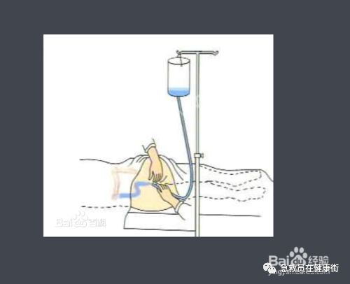 怎么无器材灌肠灌肠术（一）_https://www.jmylbn.com_新闻资讯_第35张
