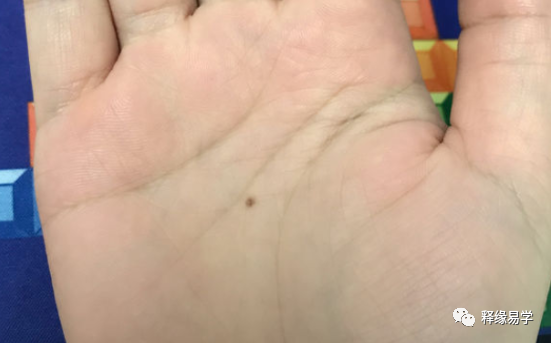 手掌中的“痣”代表哪些信息？突然长痣是好是坏？