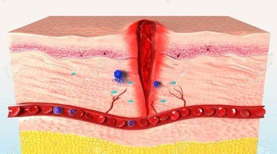 壳聚糖生物敷料治什么伤口愈合“神器”—壳聚糖功能性敷料_https://www.jmylbn.com_新闻资讯_第6张