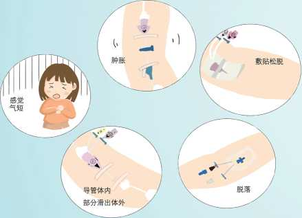 picc导管是什么材质【健康科普】什么是PICC？_https://www.jmylbn.com_新闻资讯_第37张