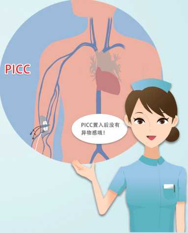 picc导管是什么材质【健康科普】什么是PICC？_https://www.jmylbn.com_新闻资讯_第6张