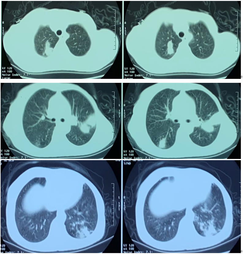 "不走寻常路"的肉芽肿性血管炎|病例分享-友友