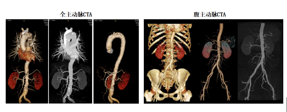 联影的CT怎么样【新设备】我院放射科联影80排CT正式投入使用_https://www.jmylbn.com_新闻资讯_第7张