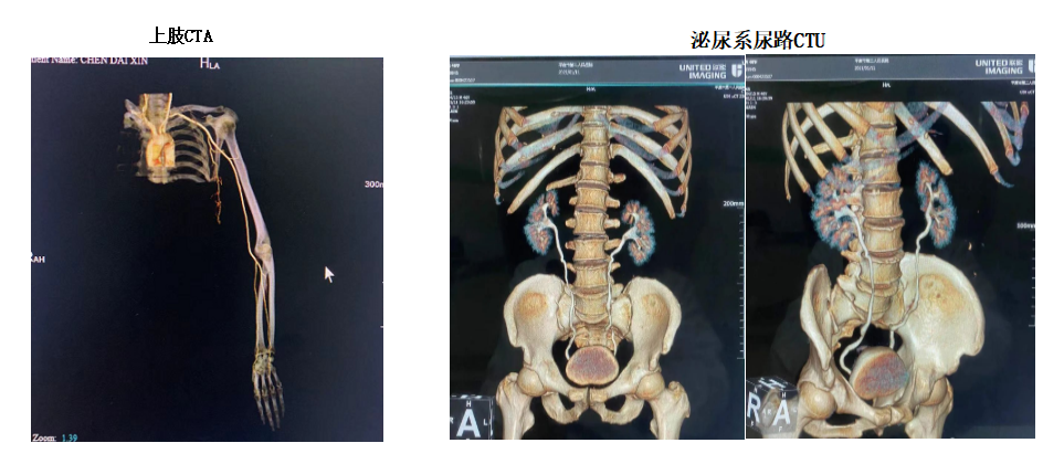 联影的CT怎么样【新设备】我院放射科联影80排CT正式投入使用_https://www.jmylbn.com_新闻资讯_第6张