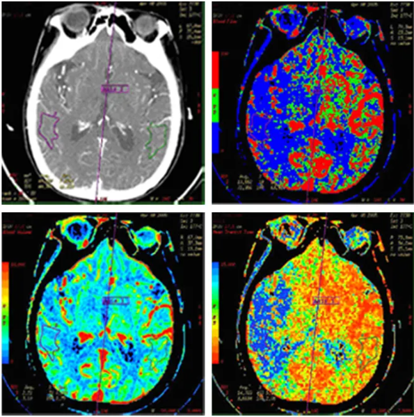 联影的CT怎么样【新设备】我院放射科联影80排CT正式投入使用_https://www.jmylbn.com_新闻资讯_第9张