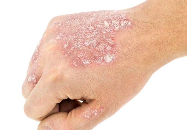 一招根除牛皮癣，永不再复发，不看后悔!