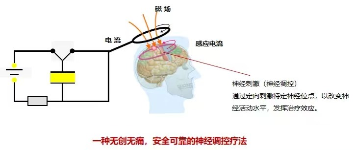 tms什么医疗失眠、失语、偏瘫，经颅磁带您从“头”开始_https://www.jmylbn.com_新闻资讯_第2张