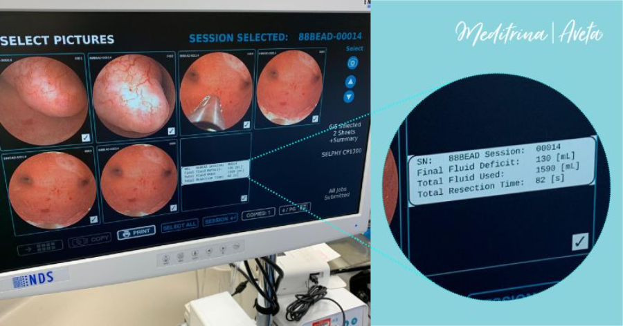 双极射频是什么获批FDA！二代双极射频宫腔镜系统！_https://www.jmylbn.com_新闻资讯_第4张
