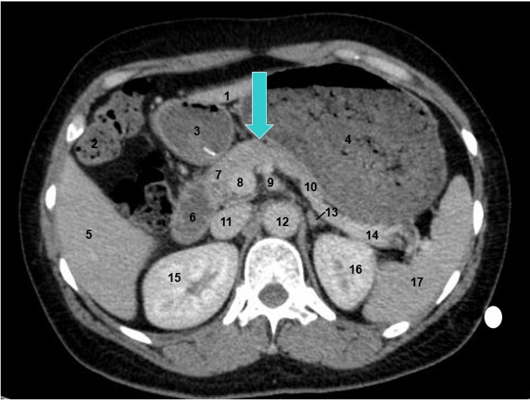 胰腺颈部:胰头,体之间狭窄而扁薄的部分.