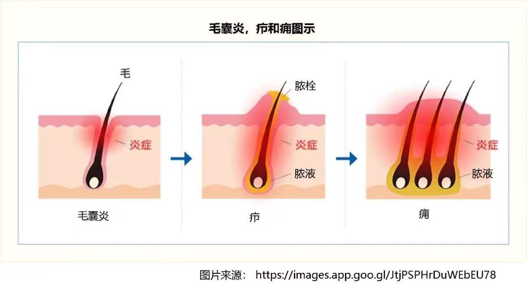 挤了一个小脓包,我的孩子做了胸腔穿刺引流......