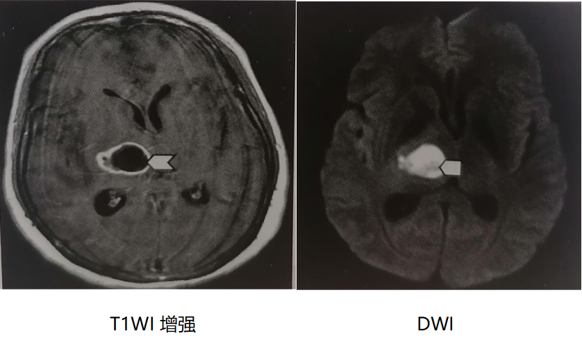 5种常见丘脑病变影像学表现2张表总结