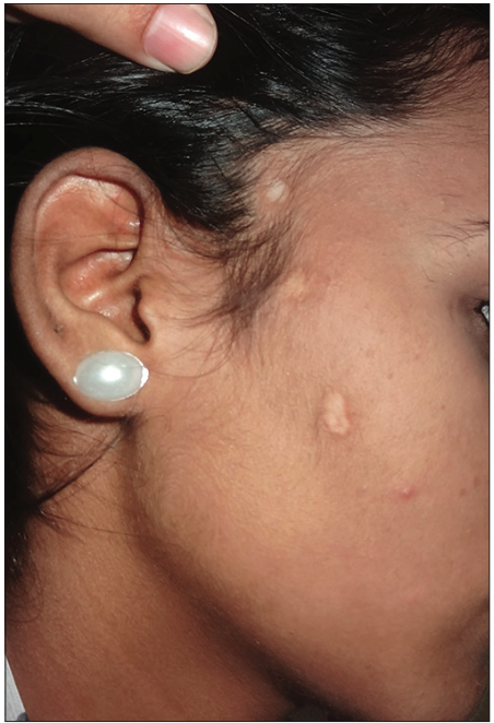 双侧面部出现的萎缩性瘢痕,会是什么病?